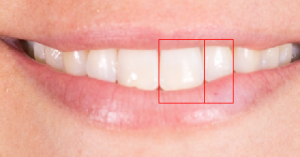 julia-calderone-teeth-width